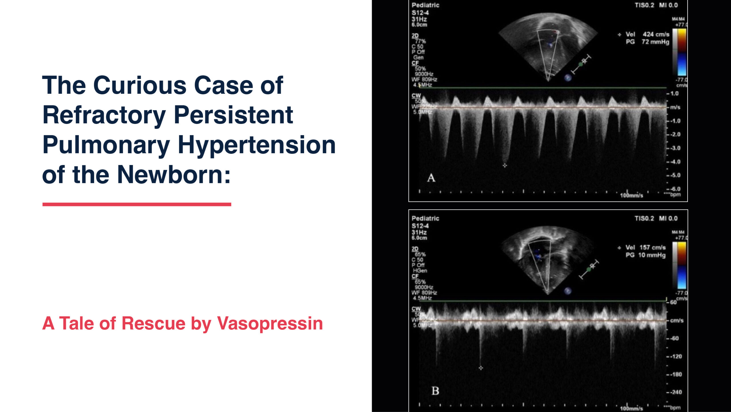 The Curious Case of Refractory Persistent Pulmonary Hypertension of the Newborn: A Tale of Rescue...