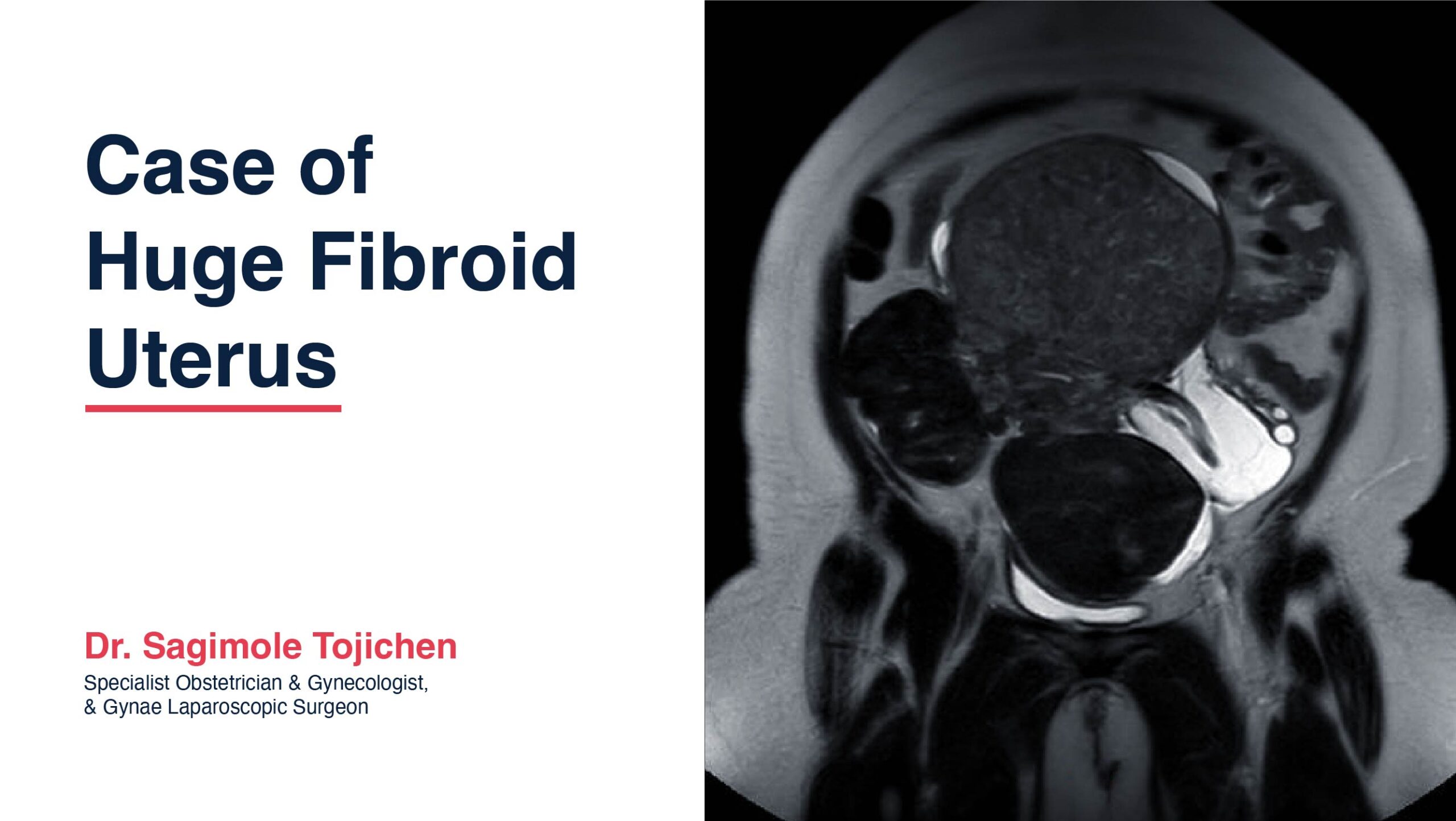 Case of huge Fibroid Uterus