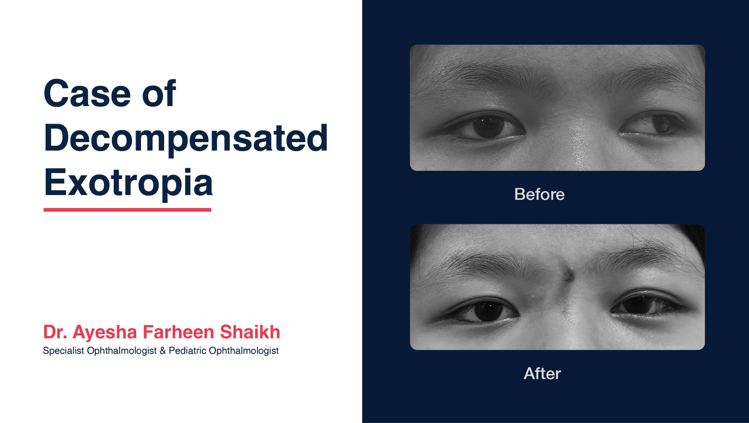 Case of Decompensated Exotropia