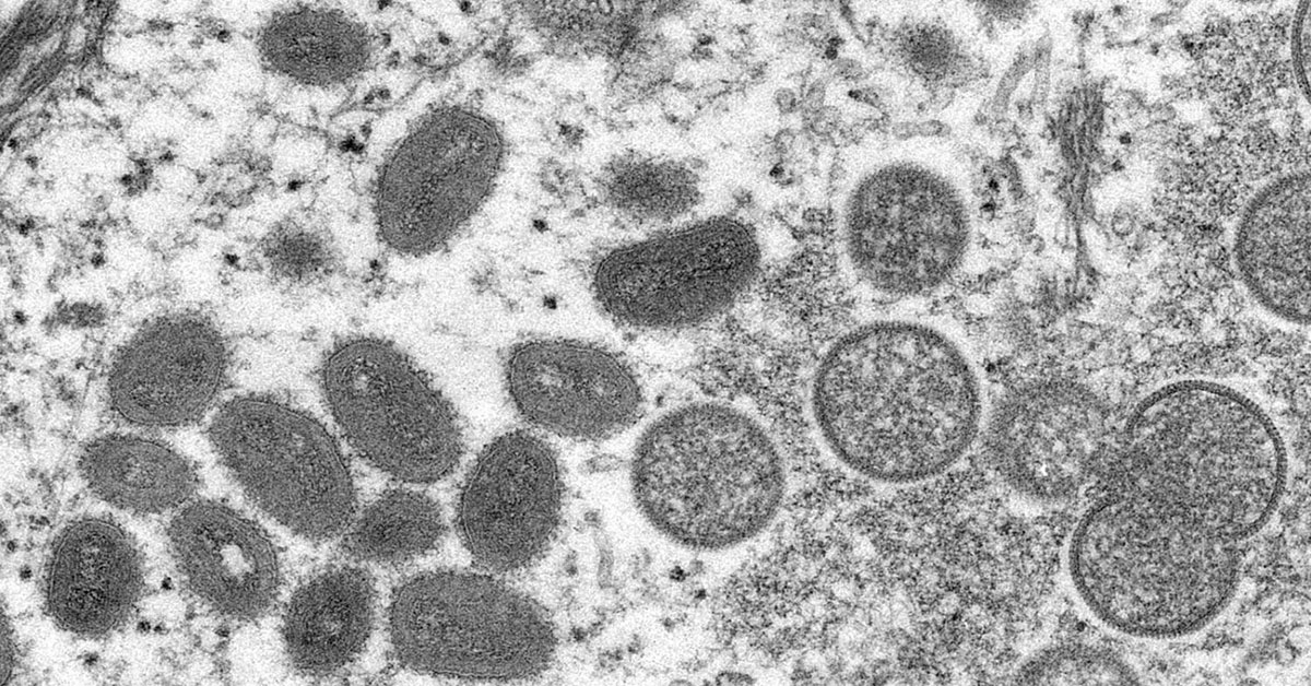 Monkeypox: UAE doctors highlight ‘precise mechanisms’ for its detection